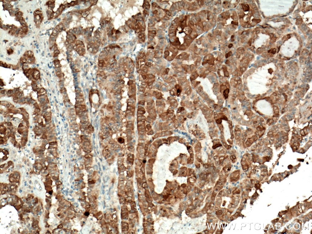 Immunohistochemistry (IHC) staining of human thyroid cancer tissue using Galectin-3 Monoclonal antibody (60207-1-Ig)