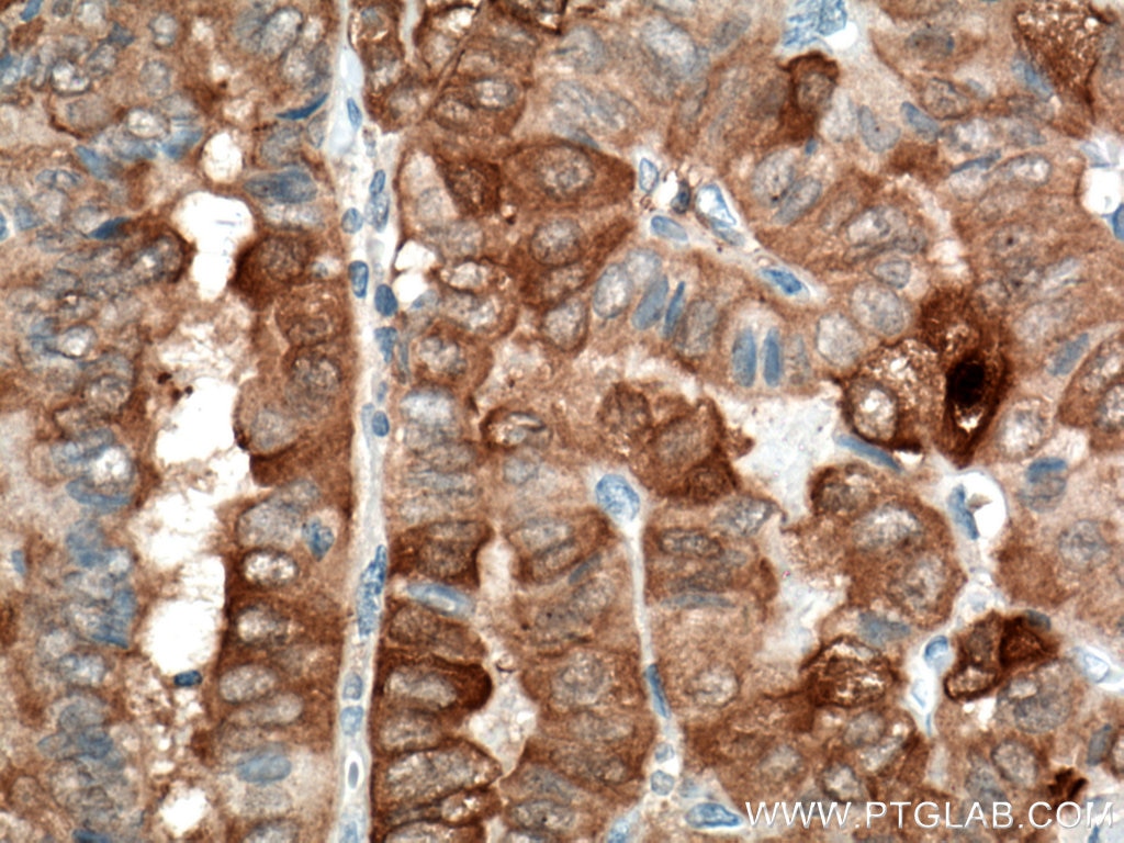 Immunohistochemistry (IHC) staining of human thyroid cancer tissue using Galectin-3 Monoclonal antibody (60207-1-Ig)
