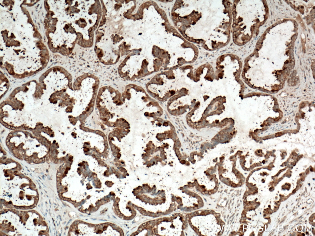 Immunohistochemistry (IHC) staining of human ovary tumor tissue using Galectin-3 Monoclonal antibody (60207-1-Ig)