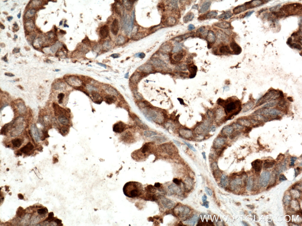 Immunohistochemistry (IHC) staining of human ovary tumor tissue using Galectin-3 Monoclonal antibody (60207-1-Ig)