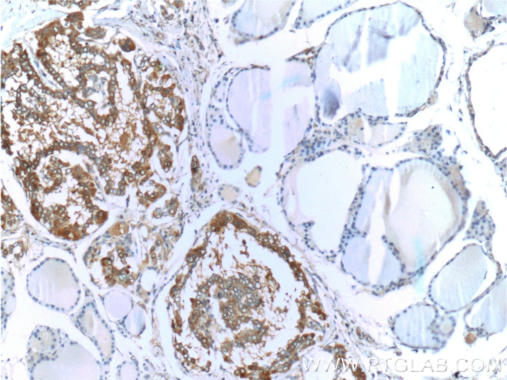 IHC staining of human thyroid cancer using 60207-1-Ig