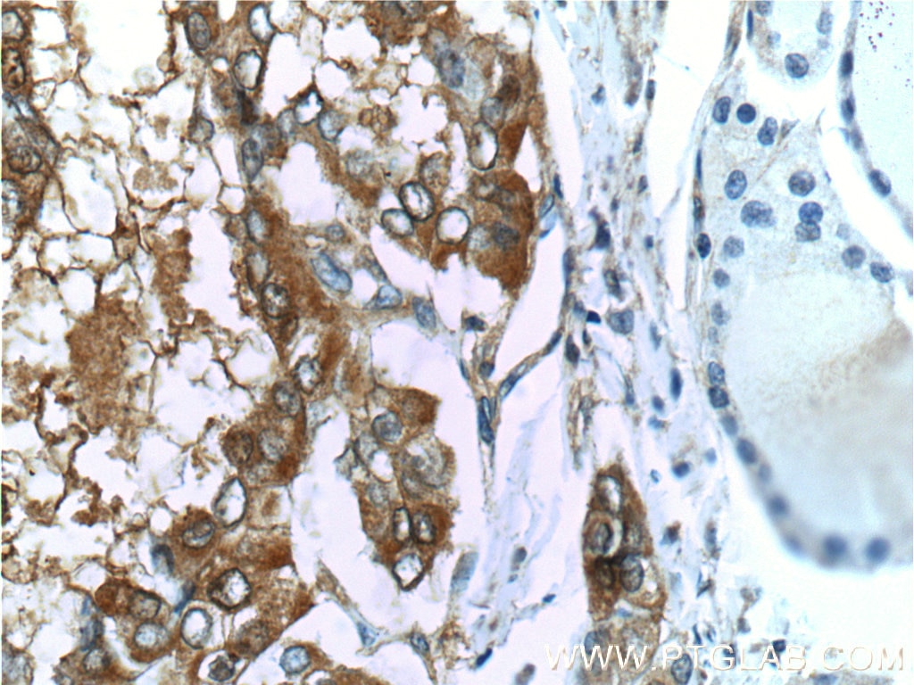 Immunohistochemistry (IHC) staining of human thyroid cancer tissue using Galectin-3 Monoclonal antibody (60207-1-Ig)