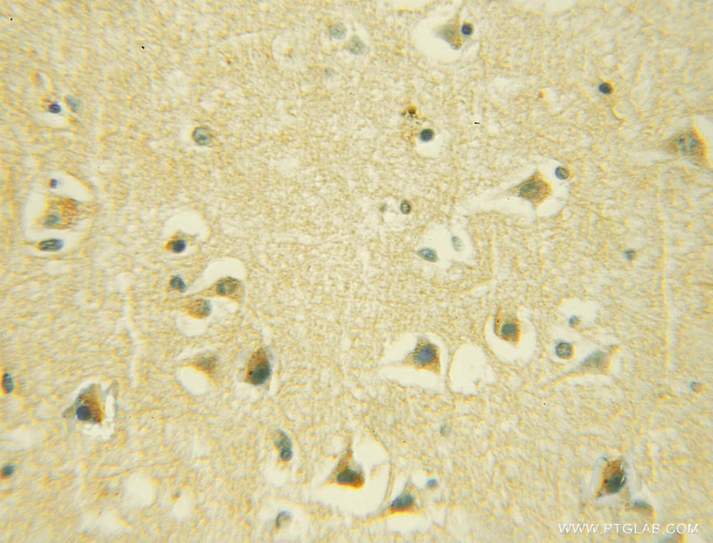 Immunohistochemistry (IHC) staining of human gliomas tissue using GALC Polyclonal antibody (51051-2-AP)