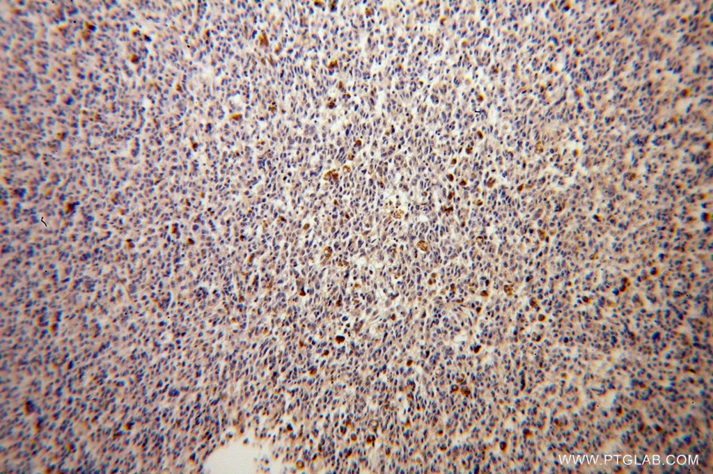 Immunohistochemistry (IHC) staining of human malignant melanoma tissue using GALE Polyclonal antibody (14414-1-AP)