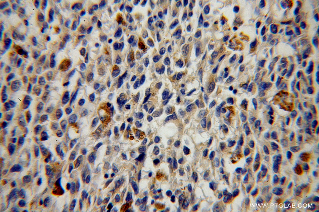 Immunohistochemistry (IHC) staining of human malignant melanoma tissue using GALE Polyclonal antibody (14414-1-AP)