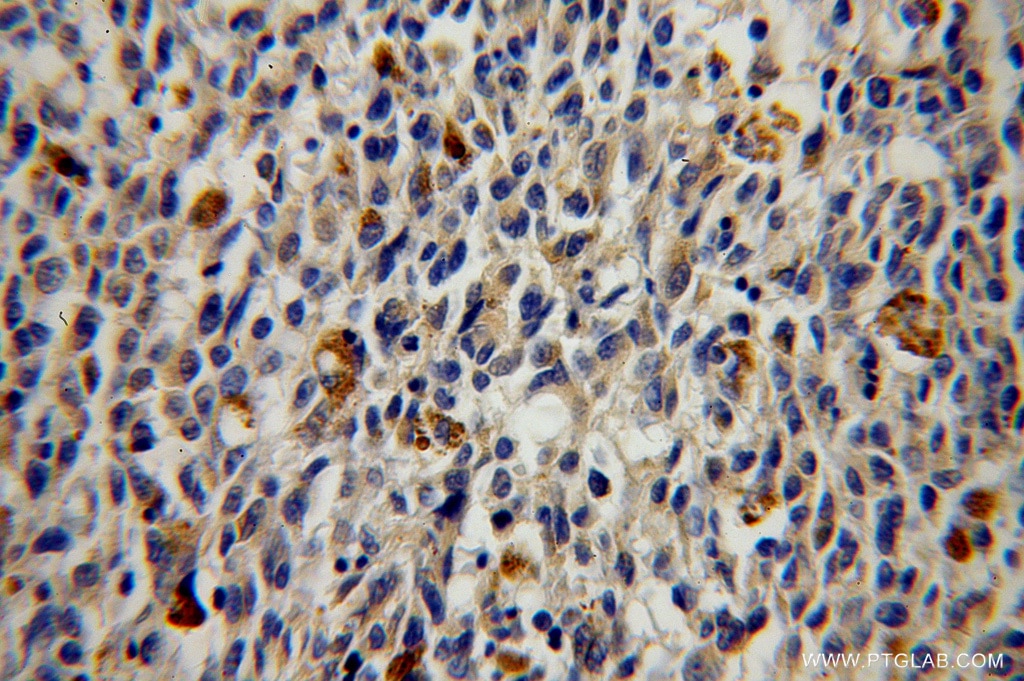 IHC staining of human malignant melanoma using 14414-1-AP