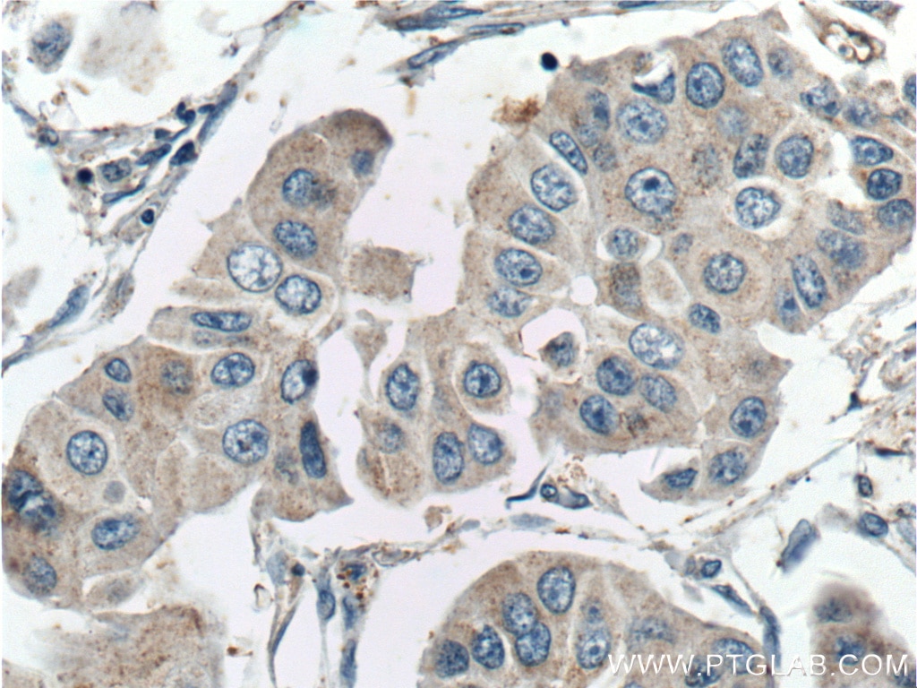 Immunohistochemistry (IHC) staining of human breast cancer tissue using GALK1 Polyclonal antibody (15284-1-AP)