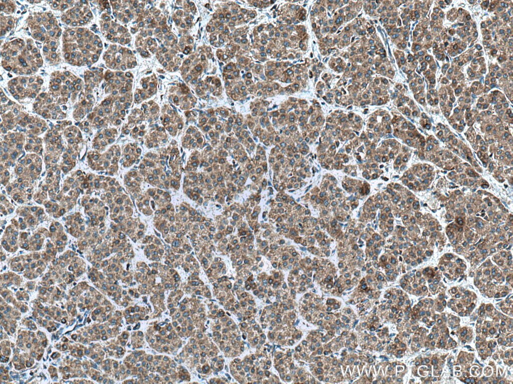 IHC staining of human liver cancer using 14933-1-AP