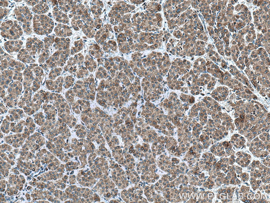 Immunohistochemistry (IHC) staining of human liver cancer tissue using GALNS Polyclonal antibody (14933-1-AP)