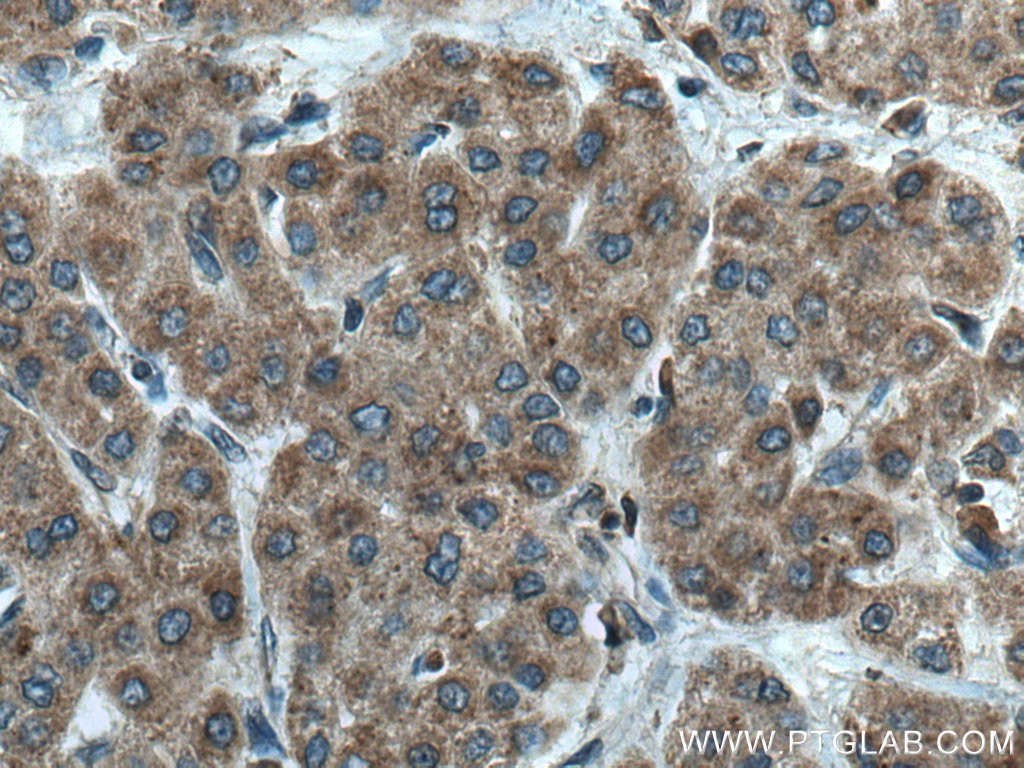 Immunohistochemistry (IHC) staining of human liver cancer tissue using GALNS Polyclonal antibody (14933-1-AP)