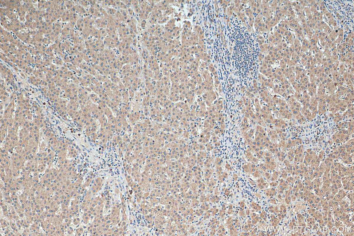 IHC staining of human liver cancer using 20822-1-AP