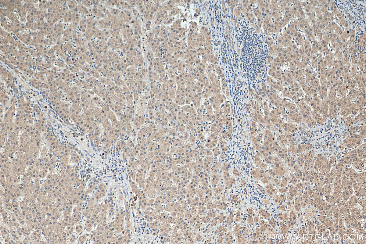 Immunohistochemistry (IHC) staining of human liver cancer tissue using GALNT10 Polyclonal antibody (20822-1-AP)