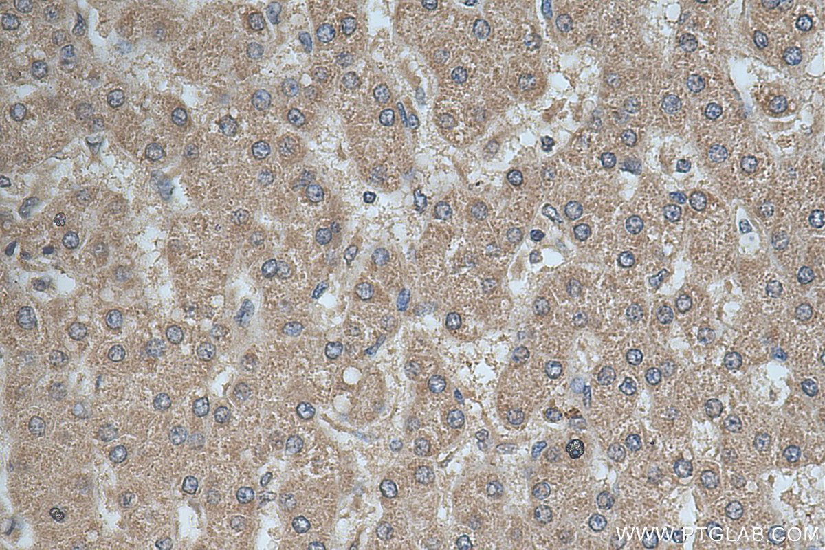 Immunohistochemistry (IHC) staining of human liver cancer tissue using GALNT10 Polyclonal antibody (20822-1-AP)