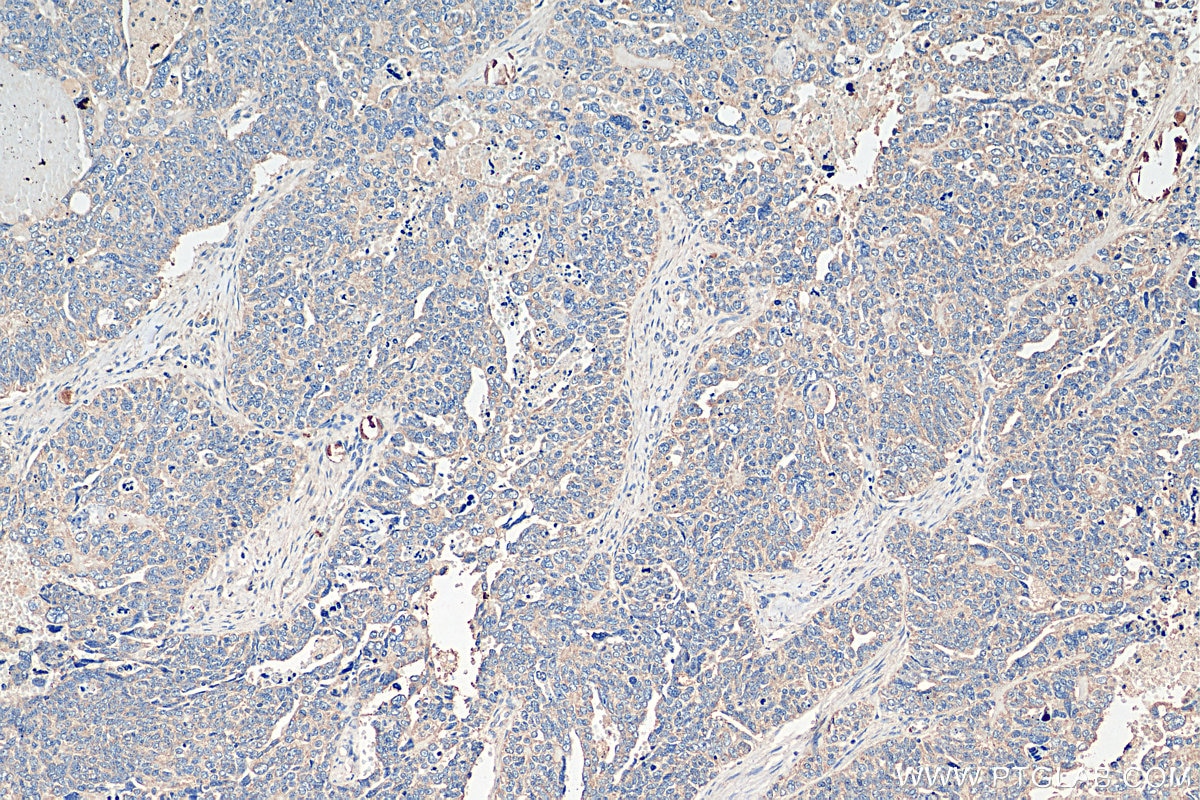 Immunohistochemistry (IHC) staining of human ovary tumor tissue using GALNT10 Polyclonal antibody (20822-1-AP)