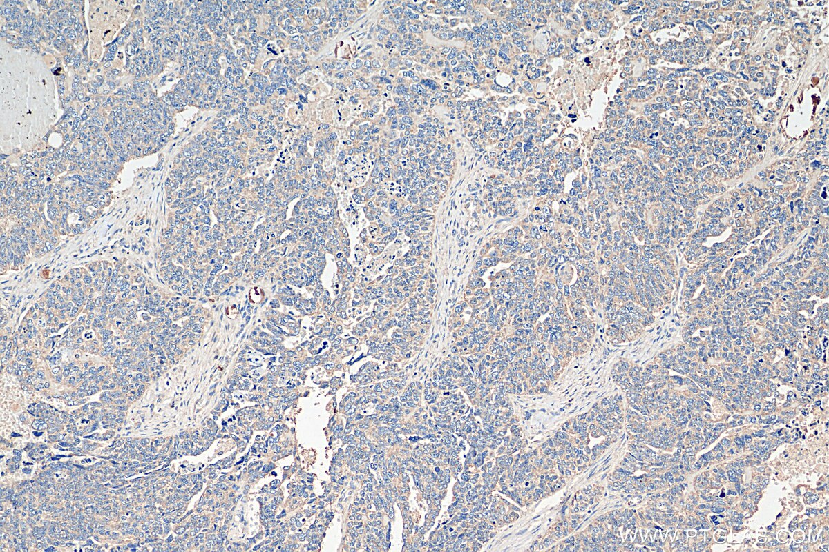 IHC staining of human ovary tumor using 20822-1-AP