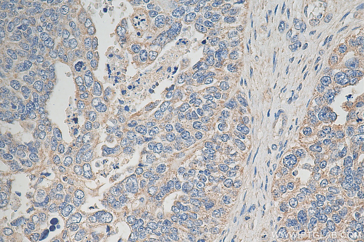 IHC staining of human ovary tumor using 20822-1-AP