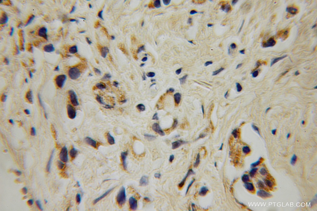 Immunohistochemistry (IHC) staining of human prostate cancer tissue using GALNT4 Polyclonal antibody (12897-1-AP)