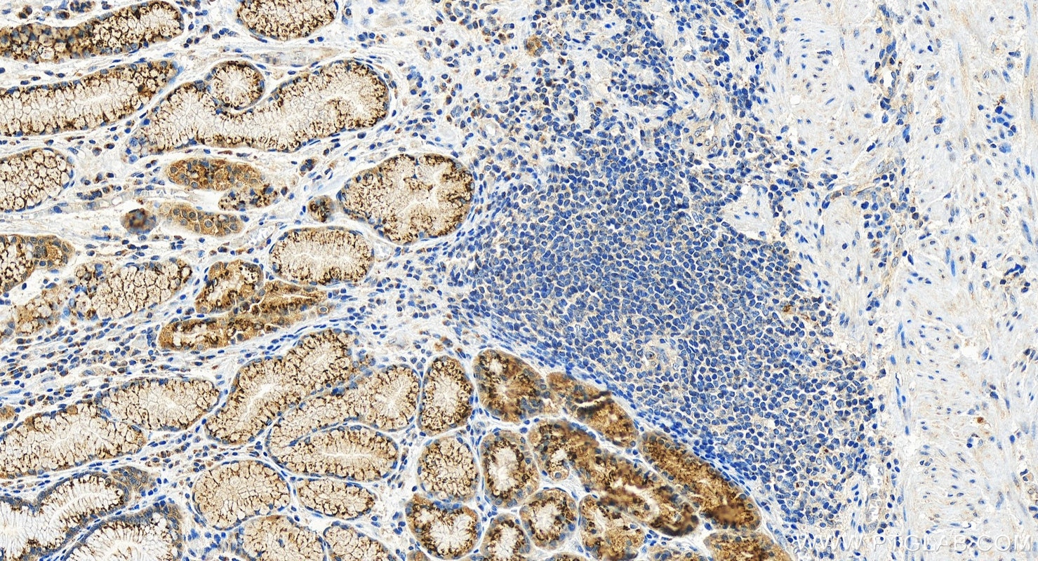 Immunohistochemical analysis of paraffin-embedded human stomach cancer tissue slide using 13671-1-AP (GALNT6 antibody) at dilution of 1:800 (under 20x lens). Heat mediated antigen retrieval with Tris-EDTA buffer (pH 9.0). Immunohistochemistry (IHC) staining of human stomach cancer tissue using GALNT6 Polyclonal antibody (13671-1-AP)