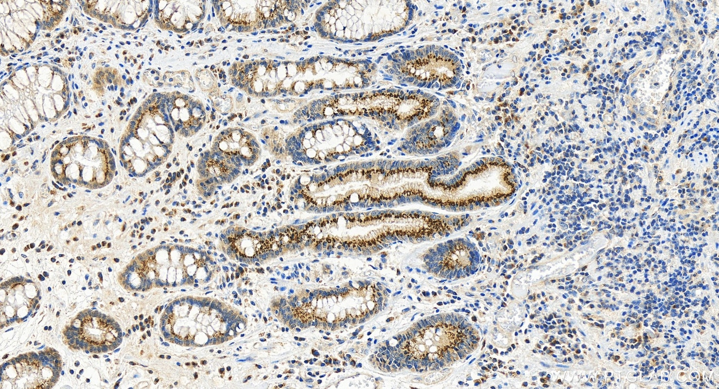 Immunohistochemical analysis of paraffin-embedded human stomach cancer tissue slide using 13671-1-AP (GALNT6 antibody) at dilution of 1:800 (under 20x lens). Heat mediated antigen retrieval with Tris-EDTA buffer (pH 9.0). Immunohistochemistry (IHC) staining of human stomach cancer tissue using GALNT6 Polyclonal antibody (13671-1-AP)