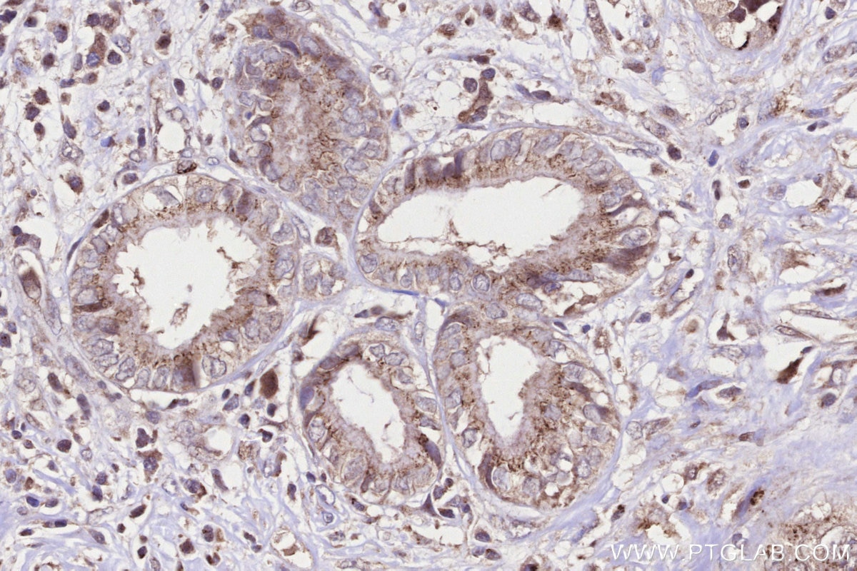 IHC staining of human pancreas cancer using 13671-1-AP Immunohistochemistry (IHC) staining of human pancreas cancer tissue using GALNT6 Polyclonal antibody (13671-1-AP)