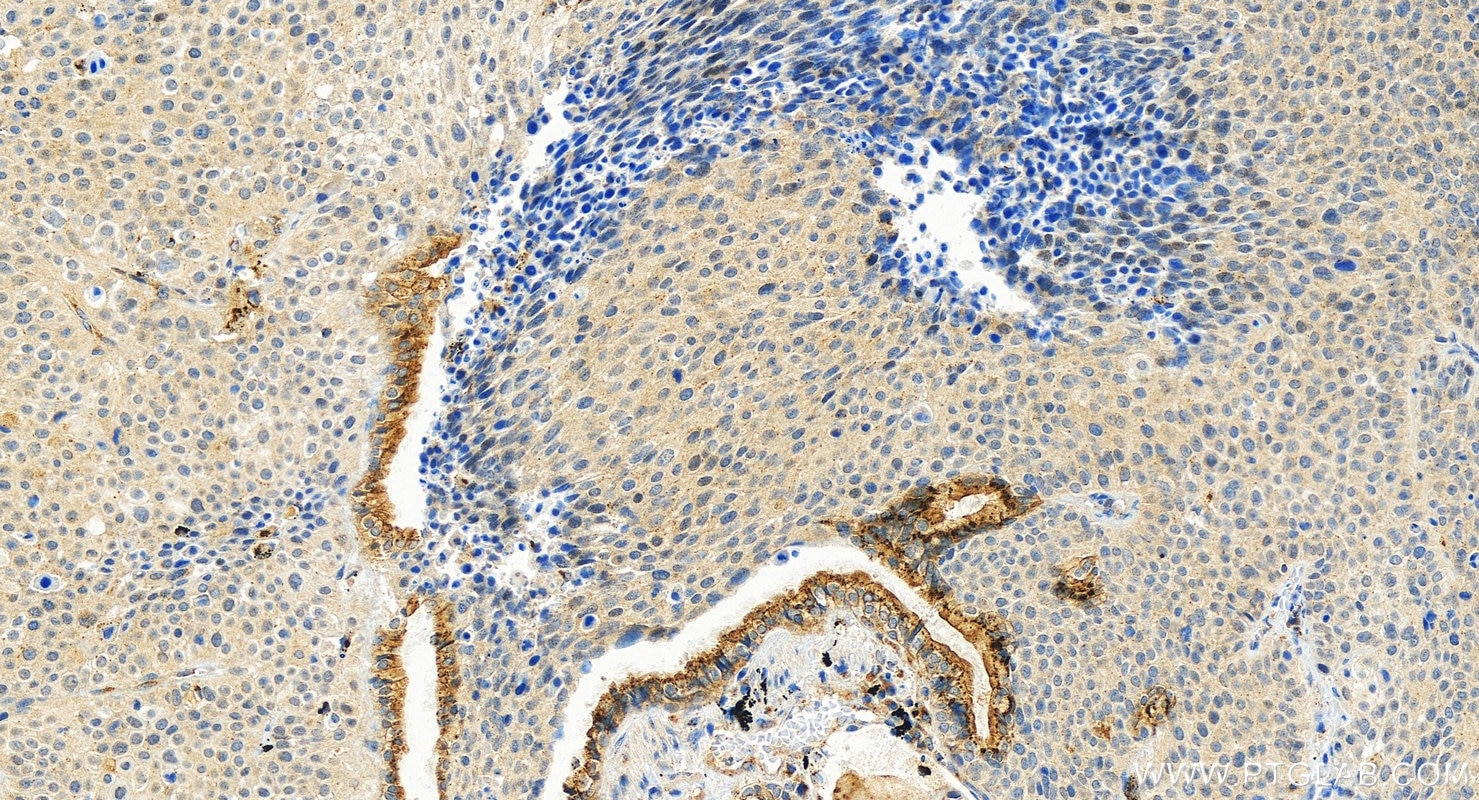 Immunohistochemical analysis of paraffin-embedded human lung squamous cell cancer slide using 13671-1-AP (GALNT6 antibody) at dilution of 1:800 (under 20x lens). Heat mediated antigen retrieval with Tris-EDTA buffer (pH 9.0). Immunohistochemistry (IHC) staining of human lung squamous cell cancer using GALNT6 Polyclonal antibody (13671-1-AP)