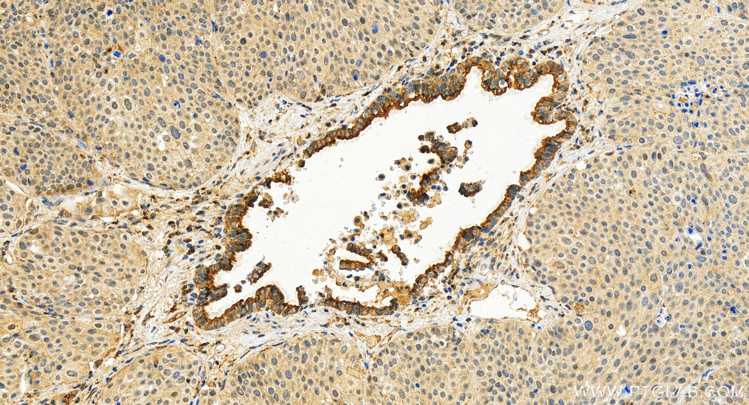 Immunohistochemical analysis of paraffin-embedded human lung squamous cell cancer slide using 13671-1-AP (GALNT6 antibody) at dilution of 1:800 (under 20x lens). Heat mediated antigen retrieval with Tris-EDTA buffer (pH 9.0). Immunohistochemistry (IHC) staining of human lung squamous cell cancer using GALNT6 Polyclonal antibody (13671-1-AP)
