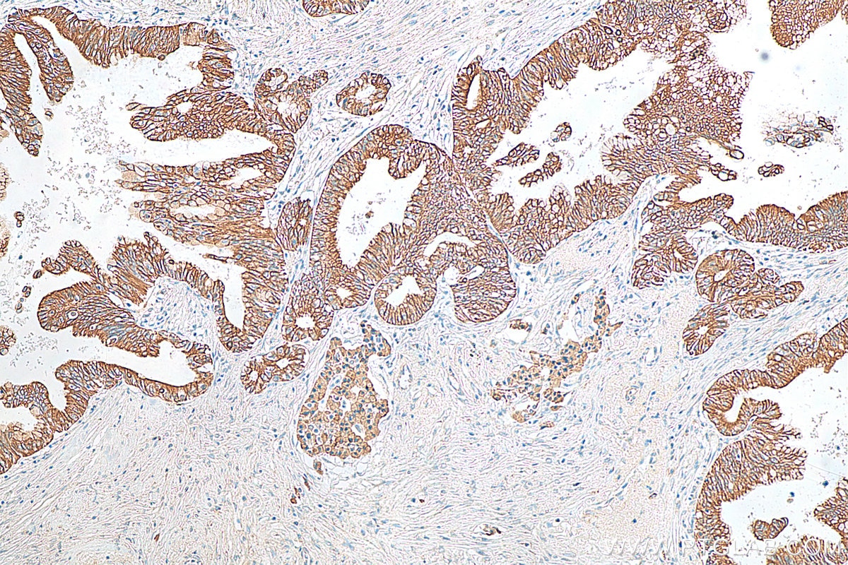 Immunohistochemistry (IHC) staining of human pancreas cancer tissue using GALR2 Polyclonal antibody (29909-1-AP)