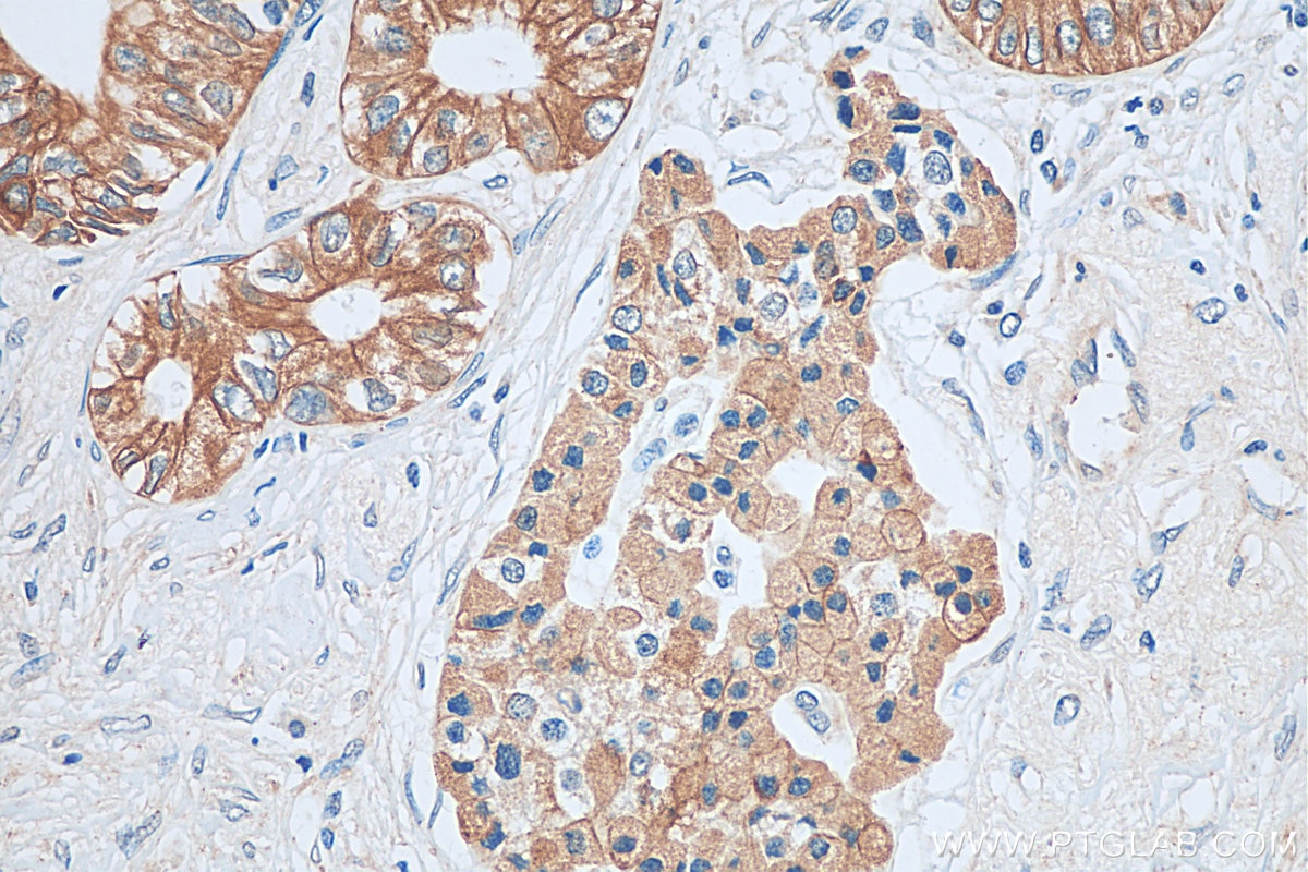 IHC staining of human pancreas cancer using 29909-1-AP