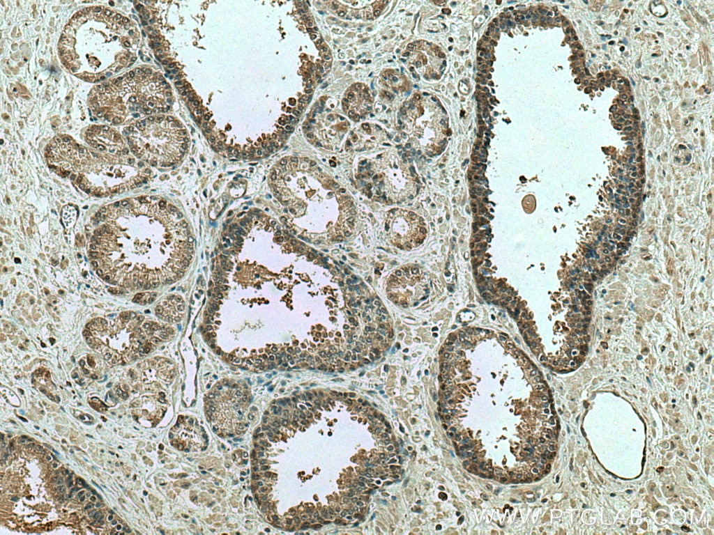IHC staining of human prostate cancer using 10880-1-AP