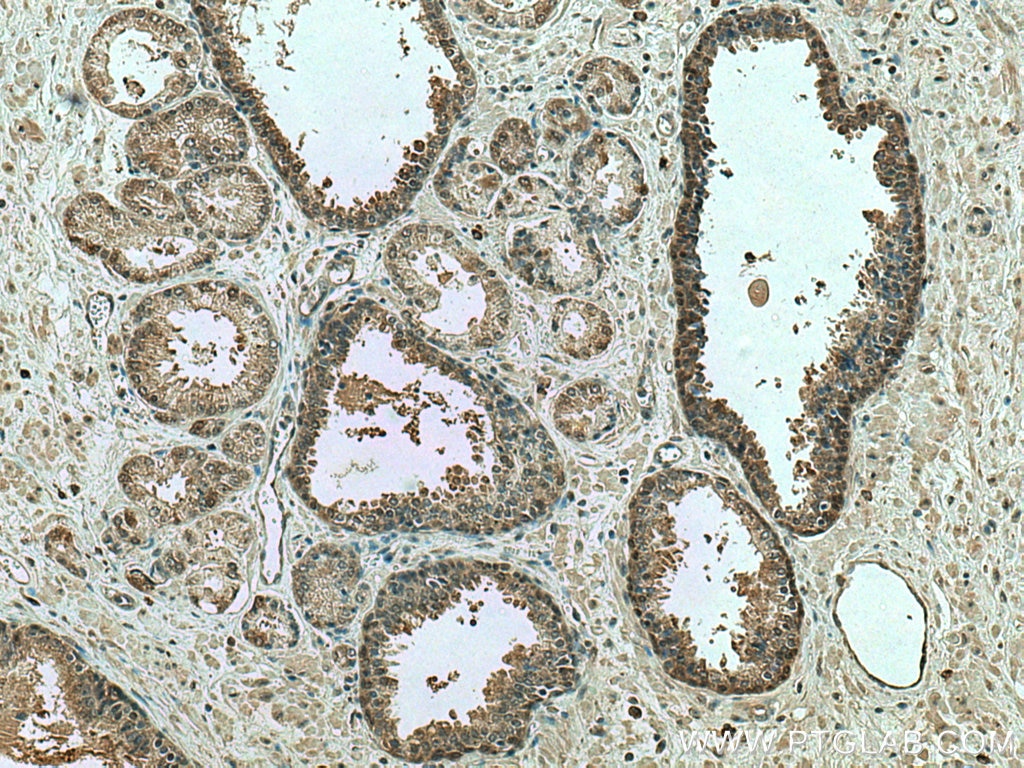 Immunohistochemistry (IHC) staining of human prostate cancer tissue using GAMT Polyclonal antibody (10880-1-AP)