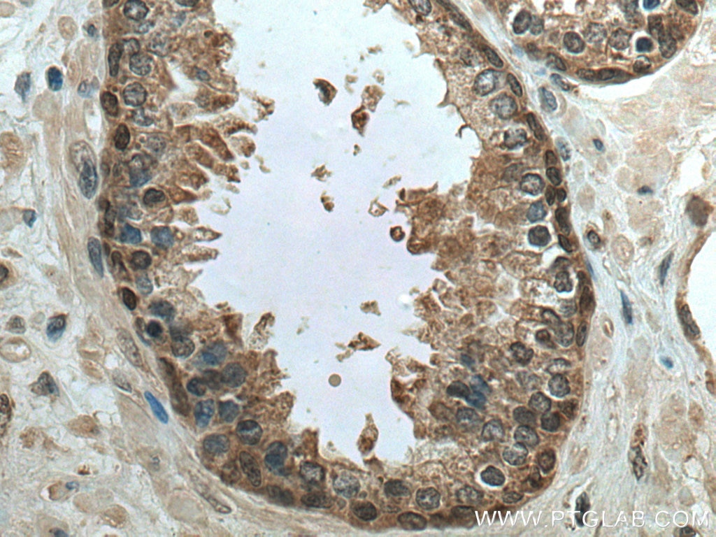 IHC staining of human prostate cancer using 10880-1-AP