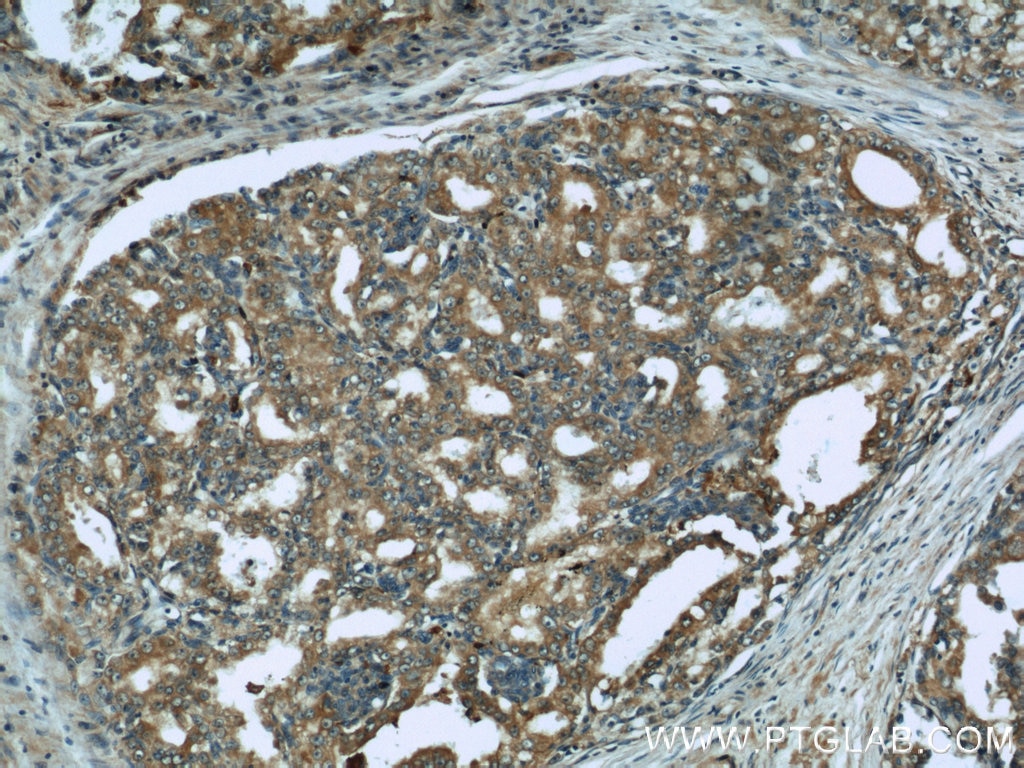 Immunohistochemistry (IHC) staining of human prostate cancer tissue using GAMT Polyclonal antibody (10880-1-AP)