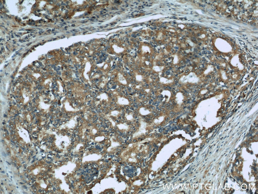 IHC staining of human prostate cancer using 10880-1-AP