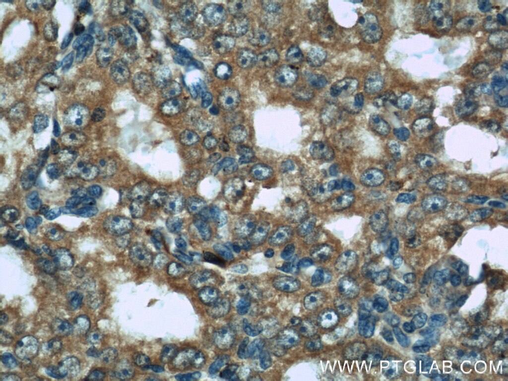 Immunohistochemistry (IHC) staining of human prostate cancer tissue using GAMT Polyclonal antibody (10880-1-AP)