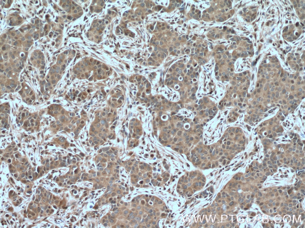 Immunohistochemistry (IHC) staining of human breast cancer tissue using GAPDH Polyclonal antibody (10494-1-AP)