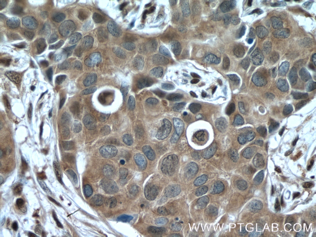 Immunohistochemistry (IHC) staining of human breast cancer tissue using GAPDH Polyclonal antibody (10494-1-AP)