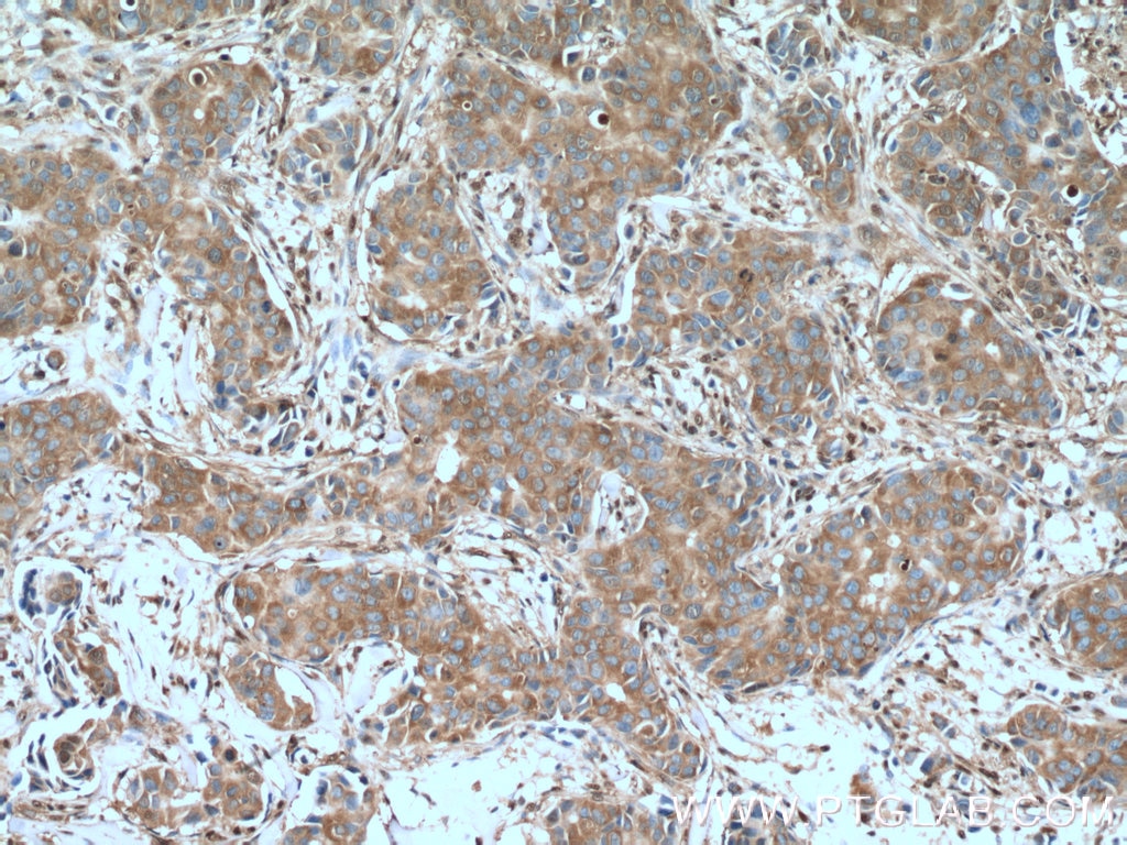 Immunohistochemistry (IHC) staining of human breast cancer tissue using GAPDH Polyclonal antibody (10494-1-AP)