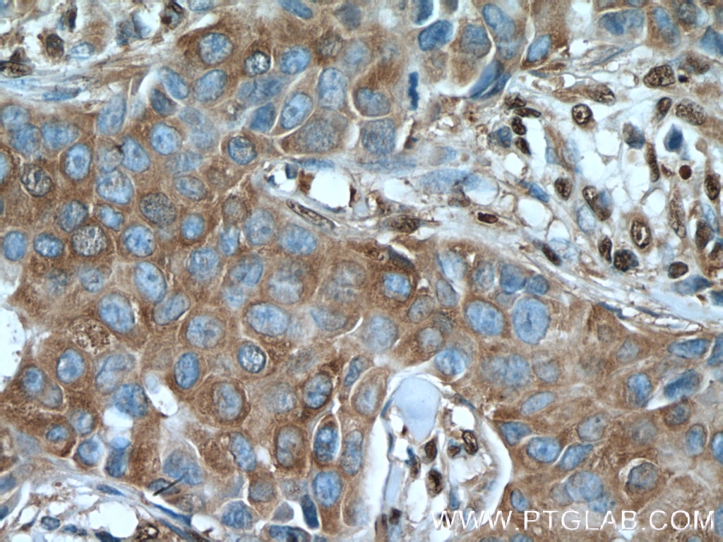 Immunohistochemistry (IHC) staining of human breast cancer tissue using GAPDH Polyclonal antibody (10494-1-AP)