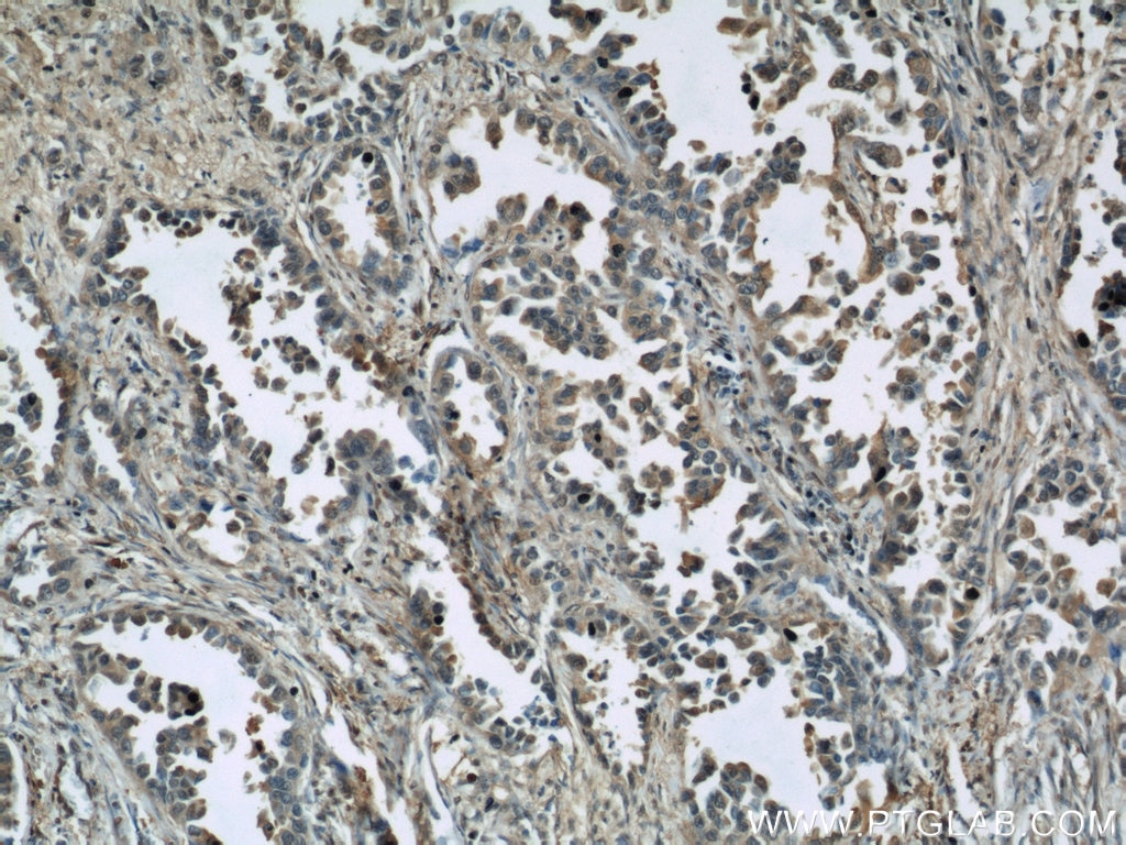 Immunohistochemistry (IHC) staining of human lung cancer tissue using GAPDH Polyclonal antibody (10494-1-AP)