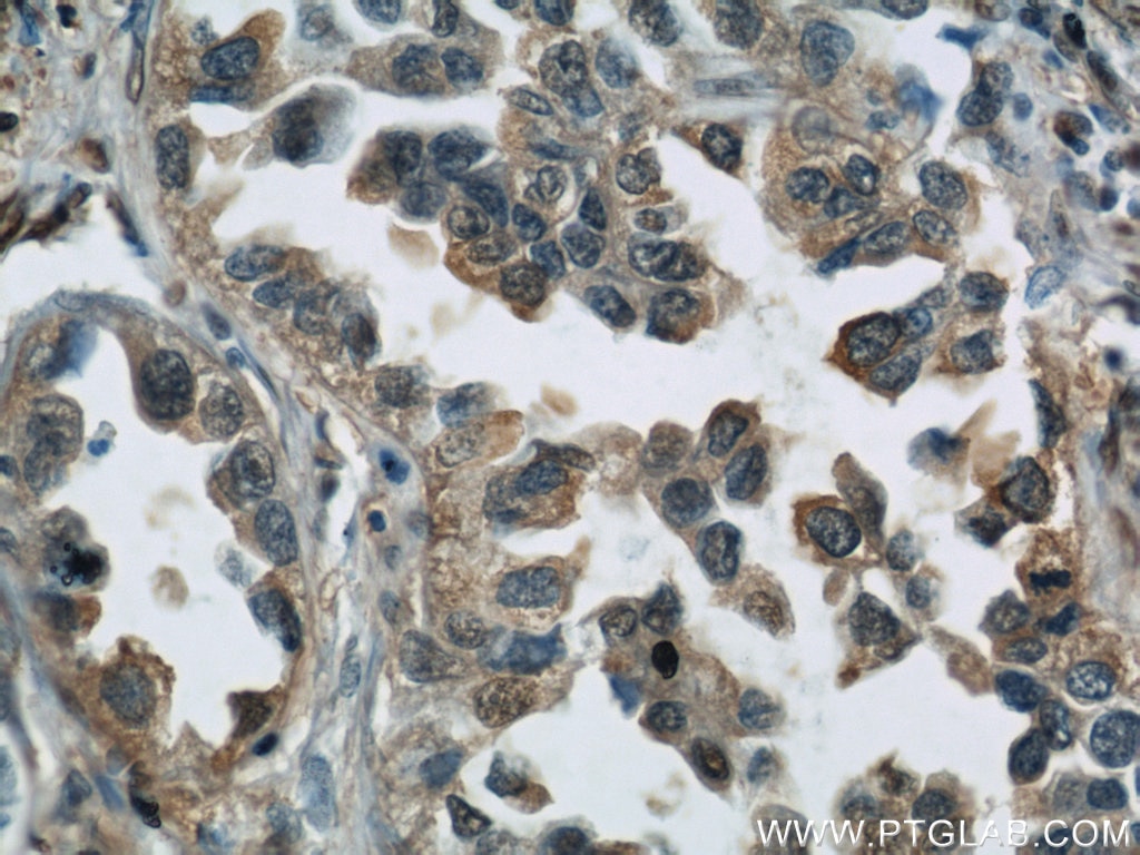 Immunohistochemistry (IHC) staining of human lung cancer tissue using GAPDH Polyclonal antibody (10494-1-AP)