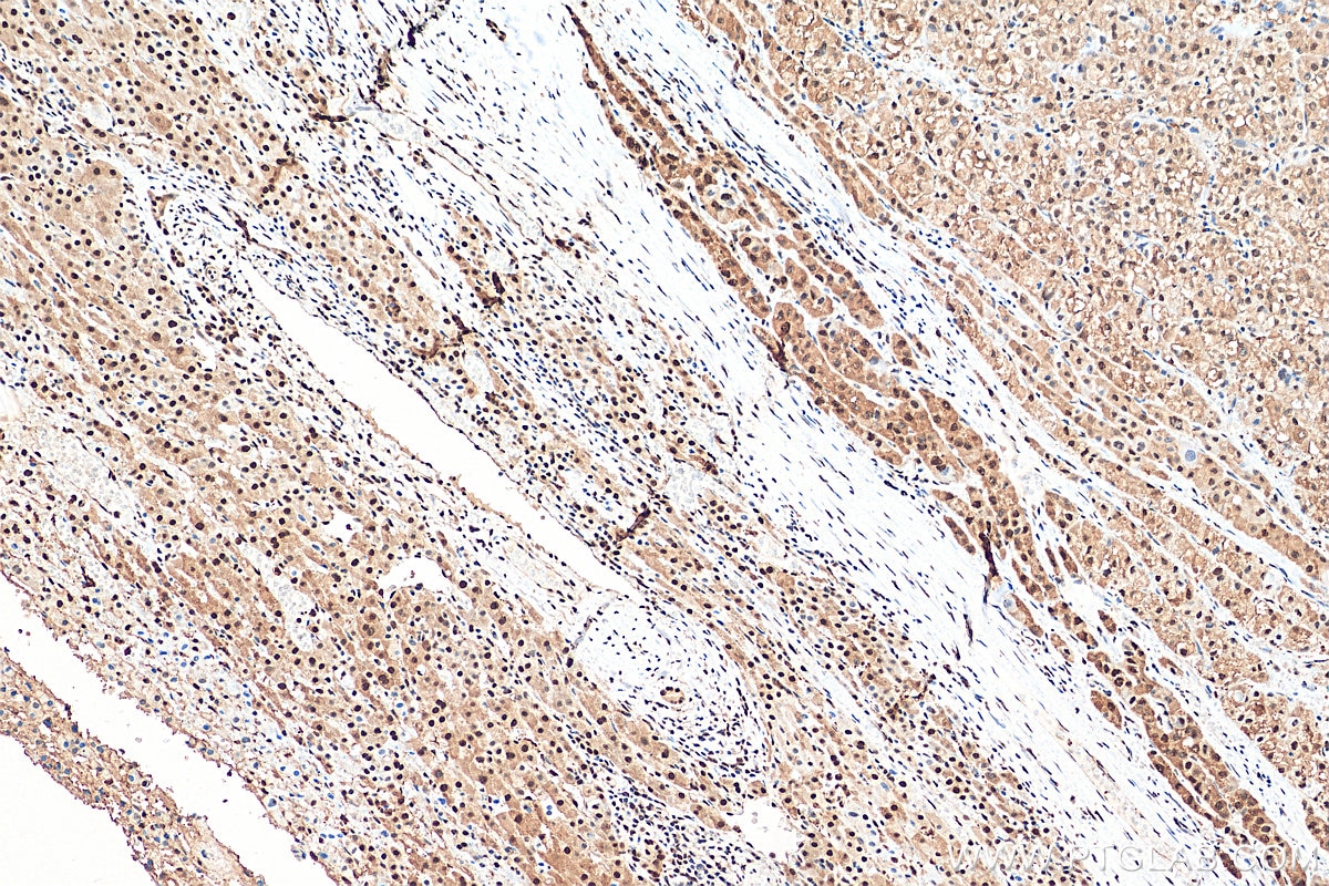 Immunohistochemistry (IHC) staining of human liver cancer tissue using GAPDH (Human Specific) Recombinant antibody (80570-1-RR)