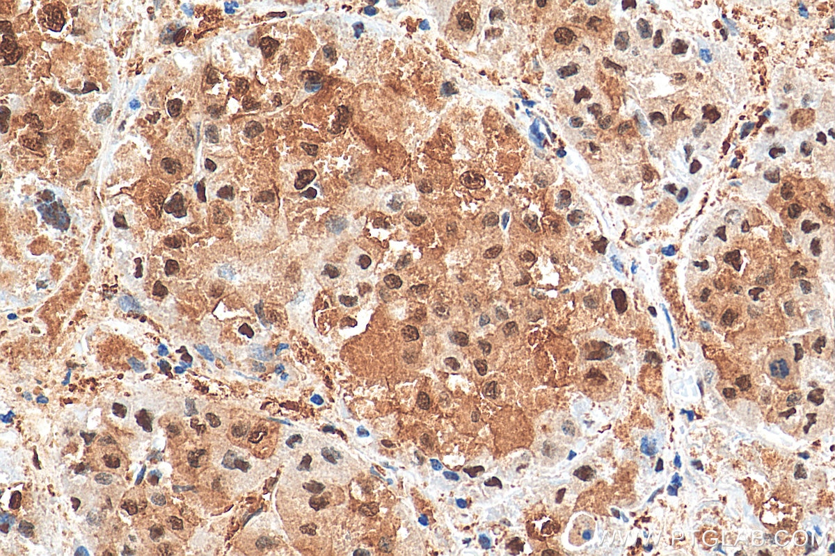 Immunohistochemistry (IHC) staining of human liver cancer tissue using GAPDH (Human Specific) Recombinant antibody (80570-1-RR)