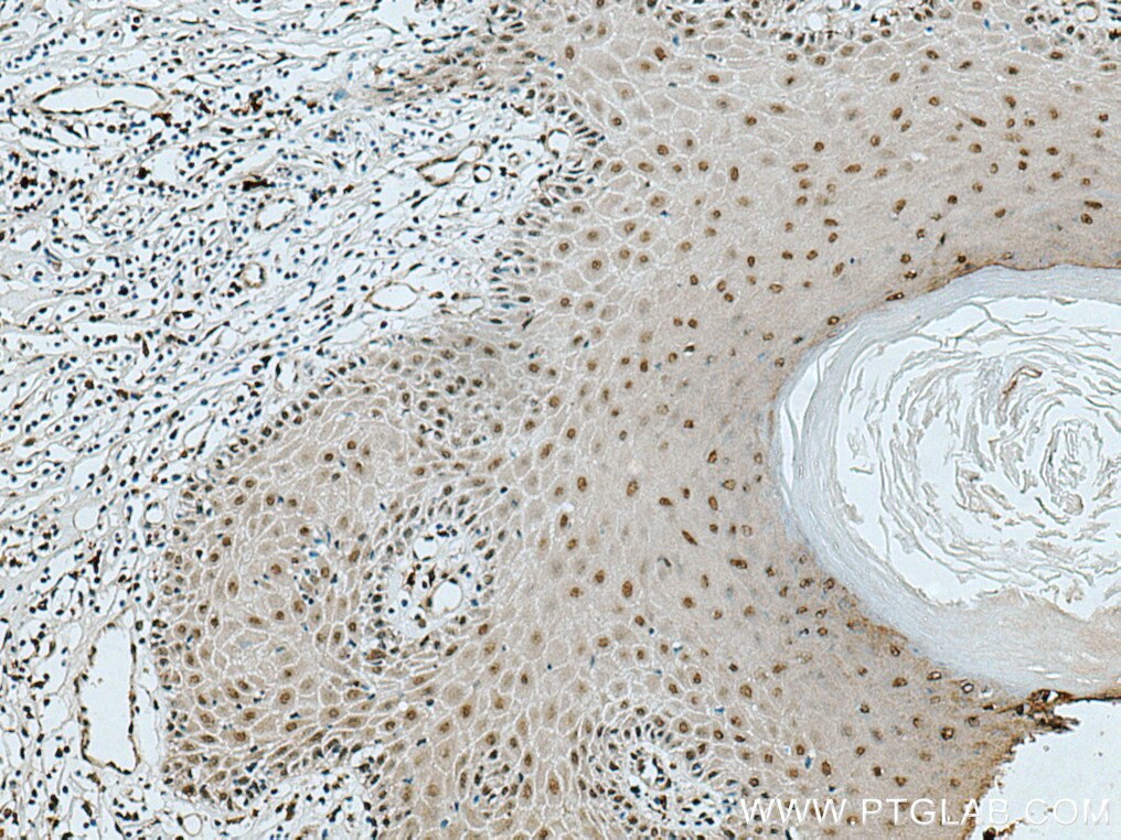 Immunohistochemistry (IHC) staining of human skin cancer tissue using GAR1 Polyclonal antibody (11711-1-AP)