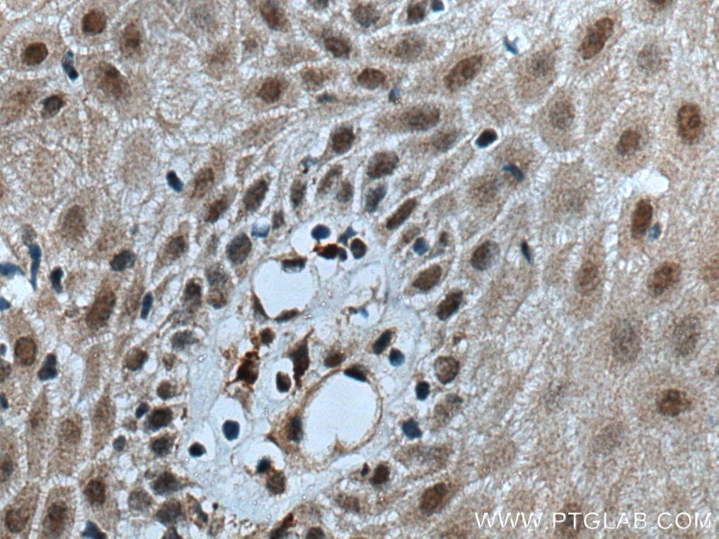 Immunohistochemistry (IHC) staining of human skin cancer tissue using GAR1 Polyclonal antibody (11711-1-AP)