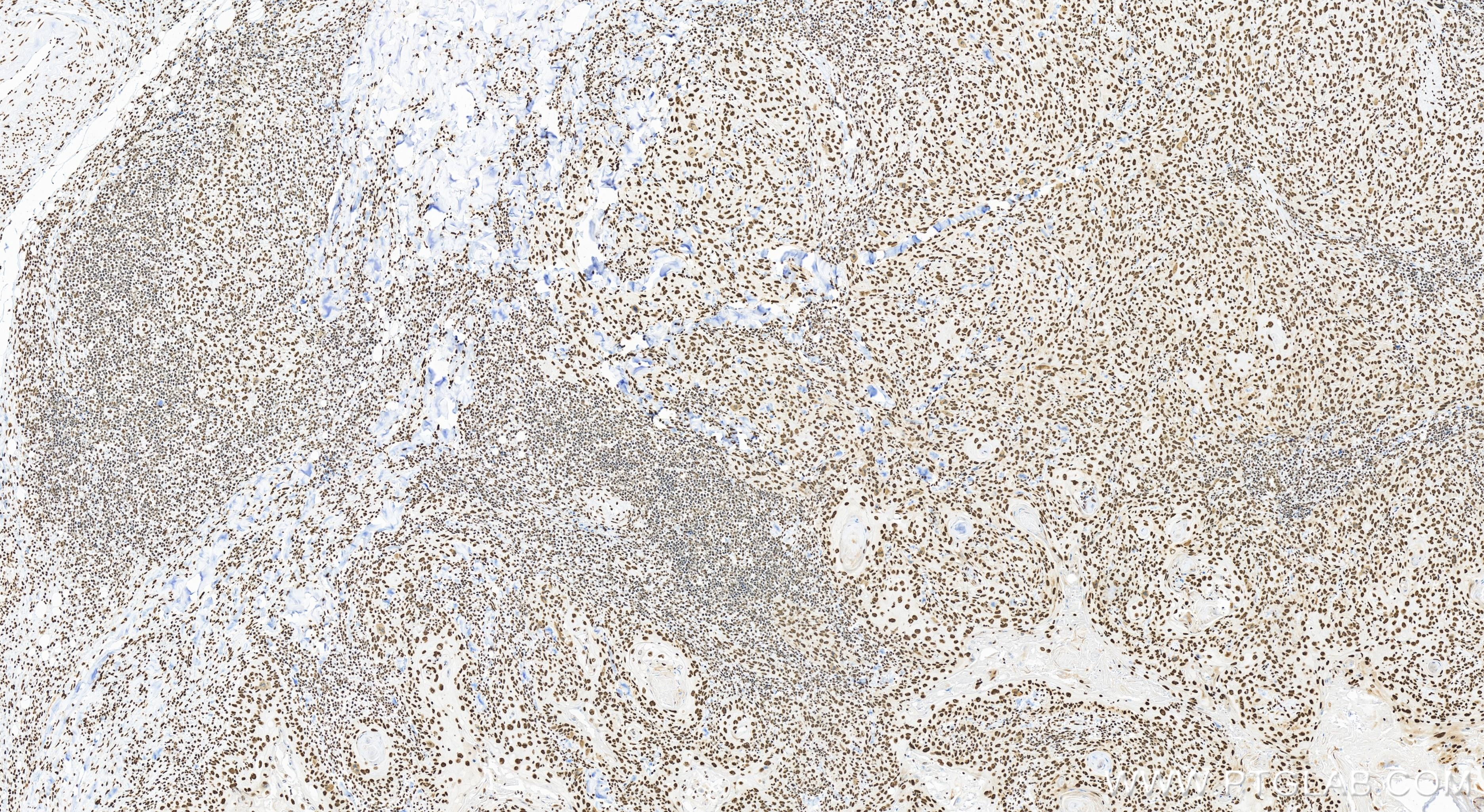 Immunohistochemistry (IHC) staining of human skin cancer tissue using GAR1 Recombinant antibody (83577-1-RR)