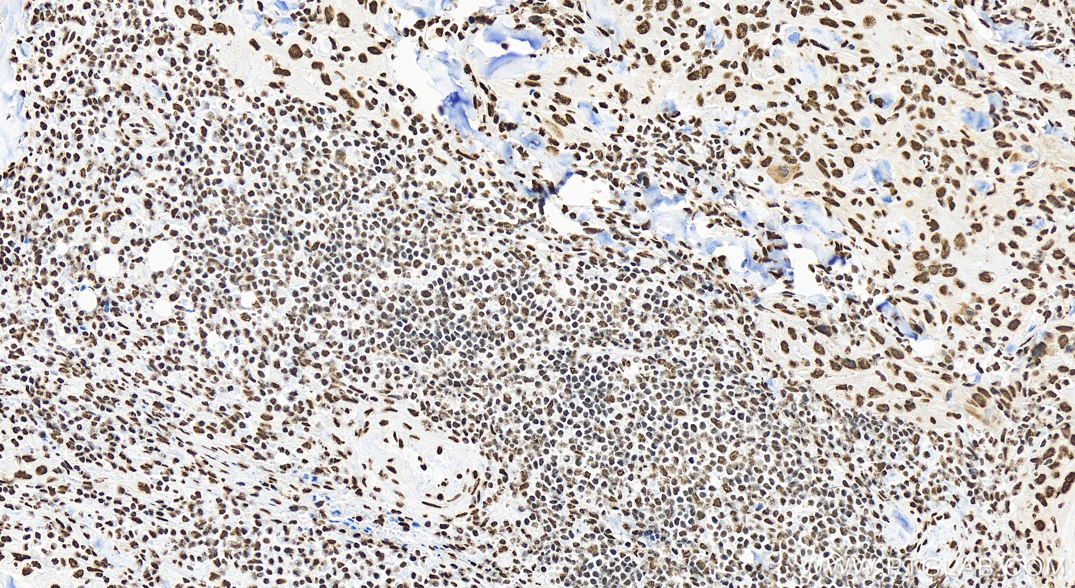 Immunohistochemistry (IHC) staining of human skin cancer tissue using GAR1 Recombinant antibody (83577-1-RR)