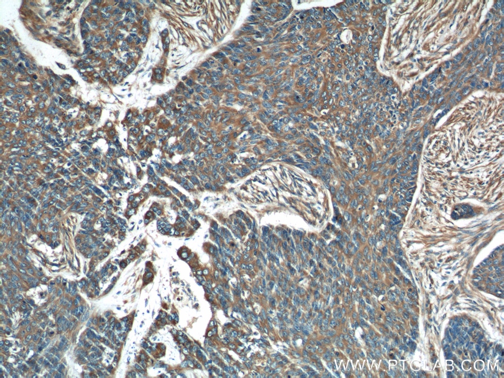 Immunohistochemistry (IHC) staining of human skin cancer tissue using GARS Polyclonal antibody (15831-1-AP)