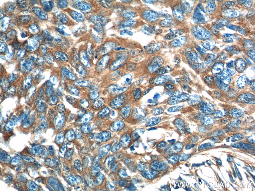 Immunohistochemistry (IHC) staining of human skin cancer tissue using GARS Polyclonal antibody (15831-1-AP)