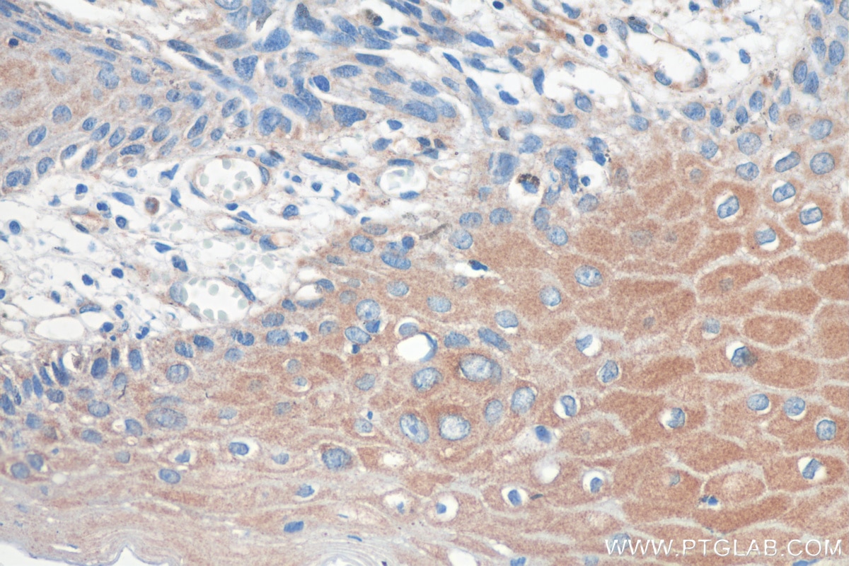 Immunohistochemistry (IHC) staining of human skin cancer tissue using GARS Monoclonal antibody (67893-1-Ig)