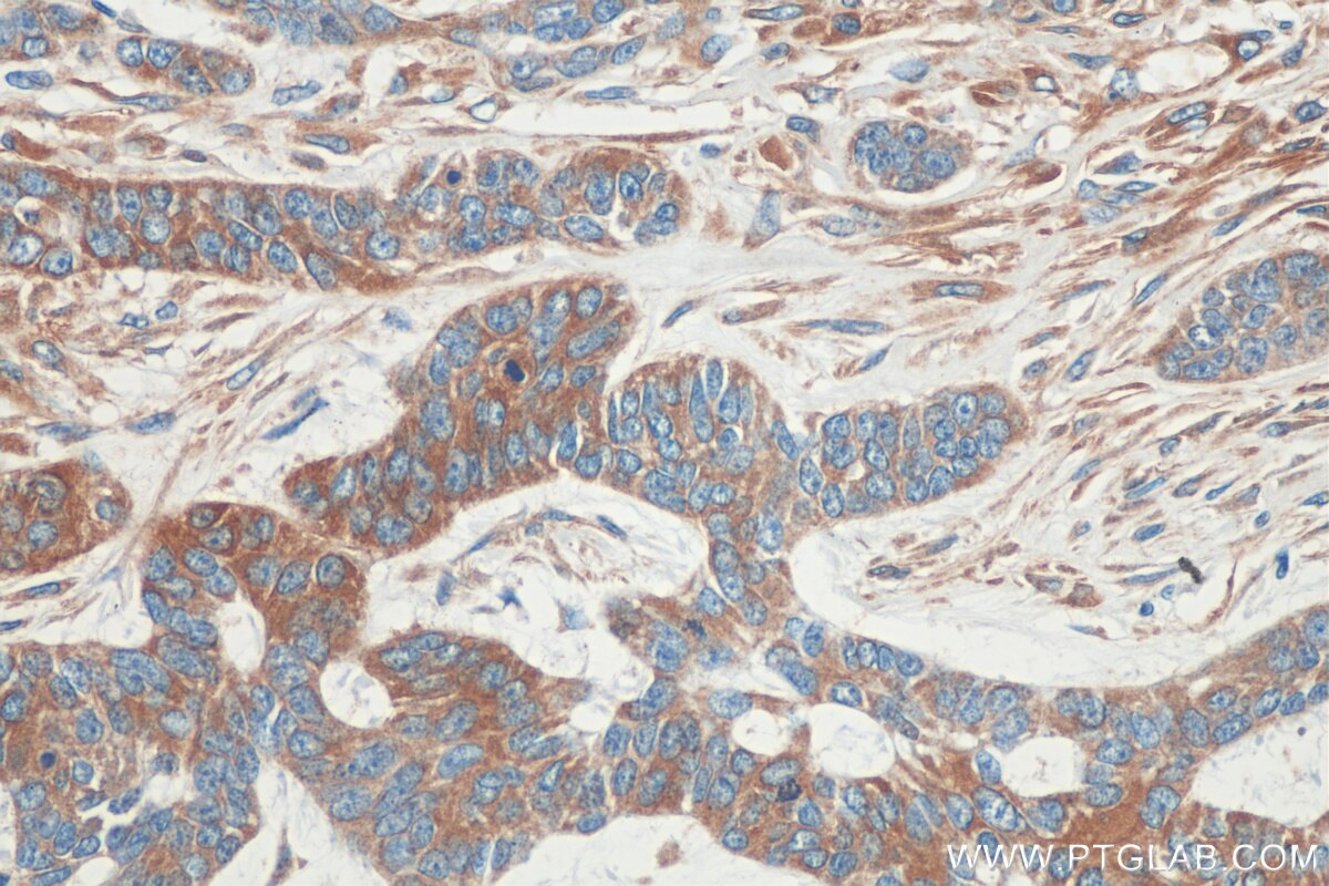 Immunohistochemistry (IHC) staining of human skin cancer tissue using GARS Monoclonal antibody (67893-1-Ig)